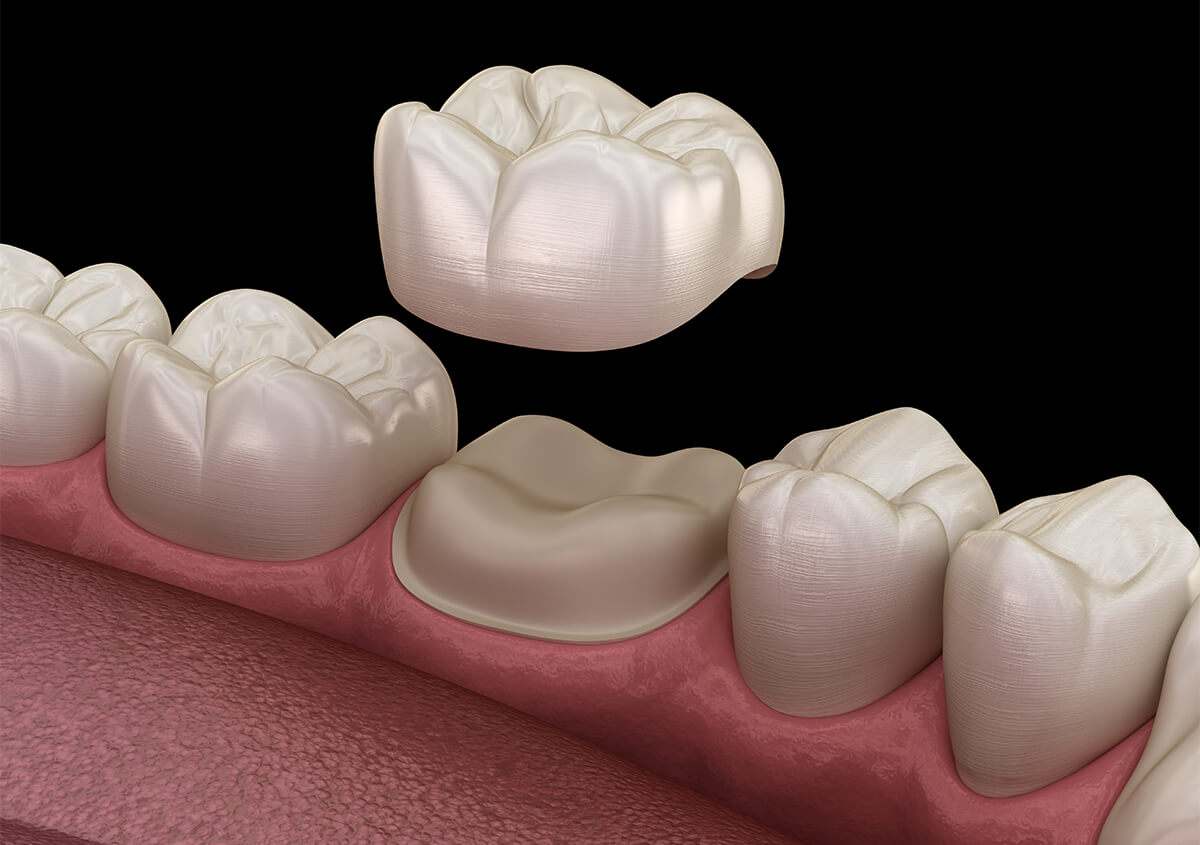 The Benefits of Restorative Dentistry for people with Damaged Teeth