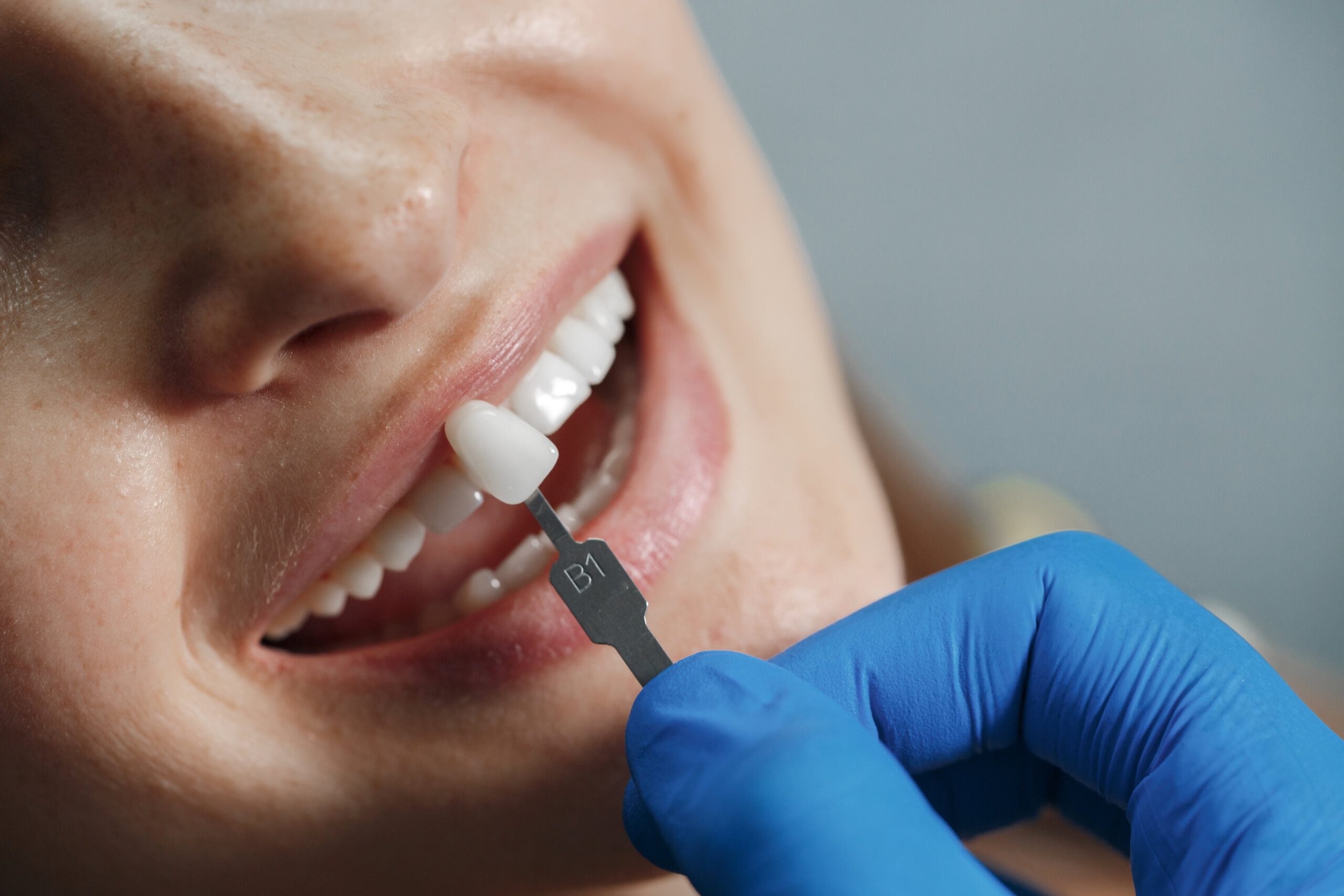 The Best Dentist for Veneers : Smile Transformation Starts Here