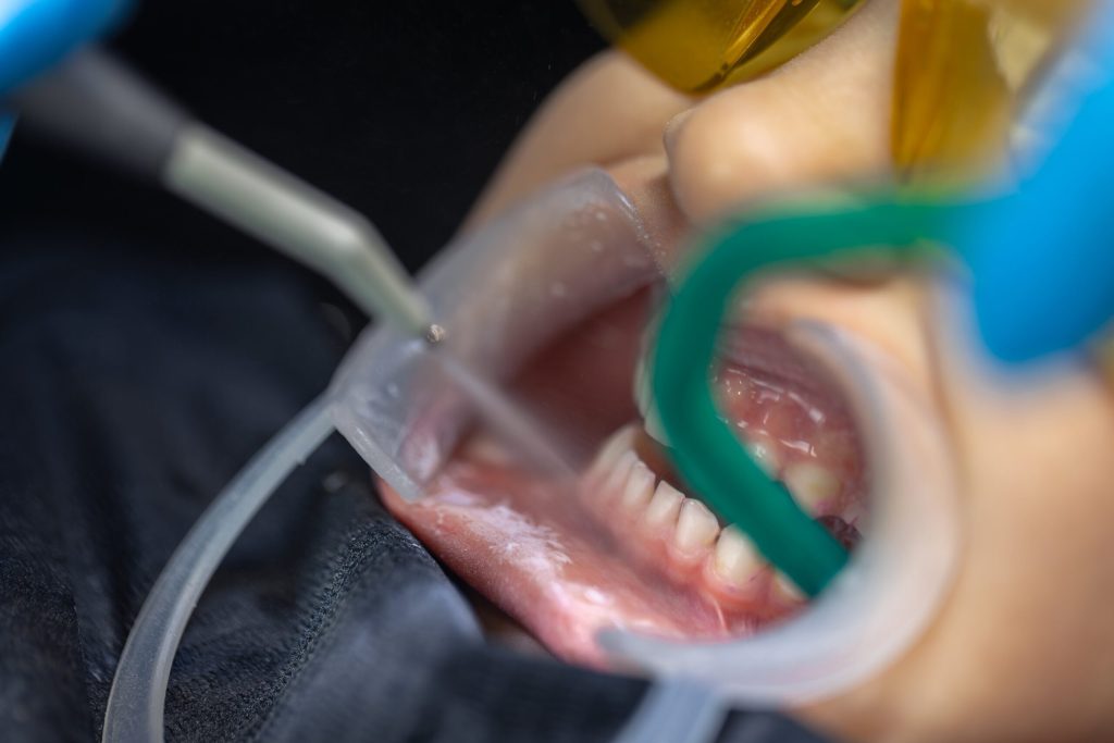 Dental Treatment Under General Anesthesia