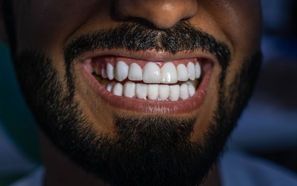Hollywood Smile Design in Islamabad