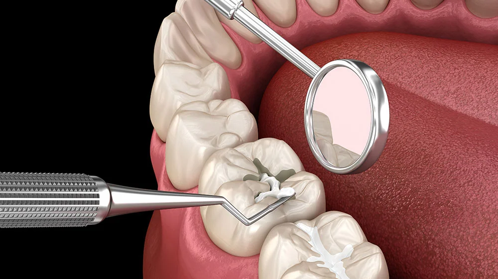 Teeth Filling in Islamabad