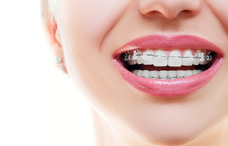 dental braces in Islamabad Pakistan