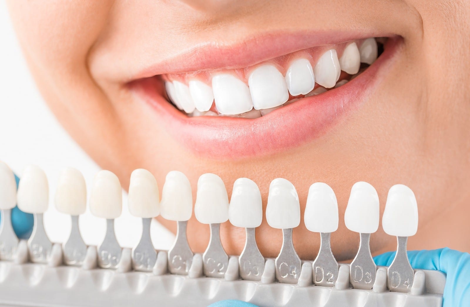 dental veneers in Islamabad