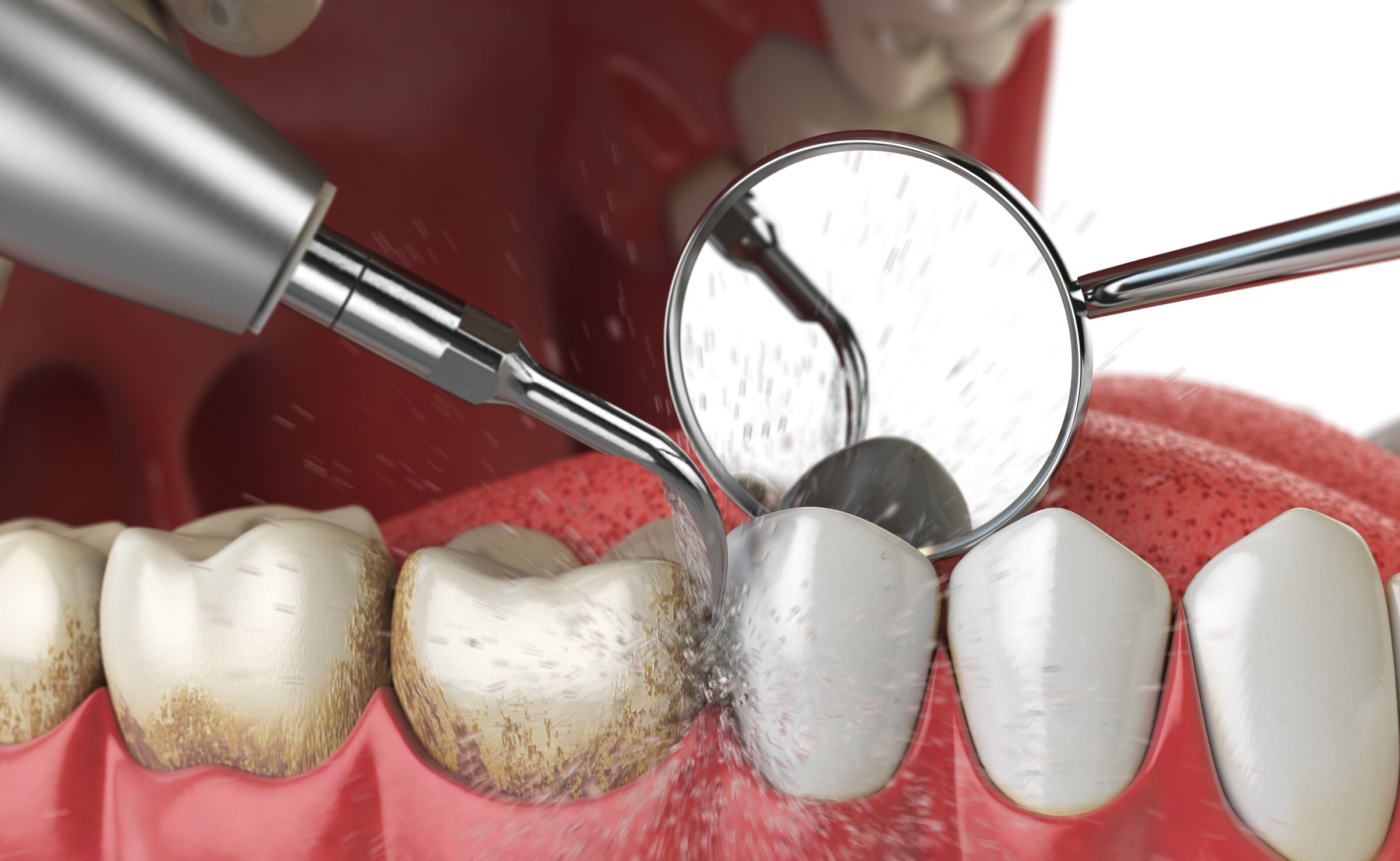 How Is Teeth Scaling Done?