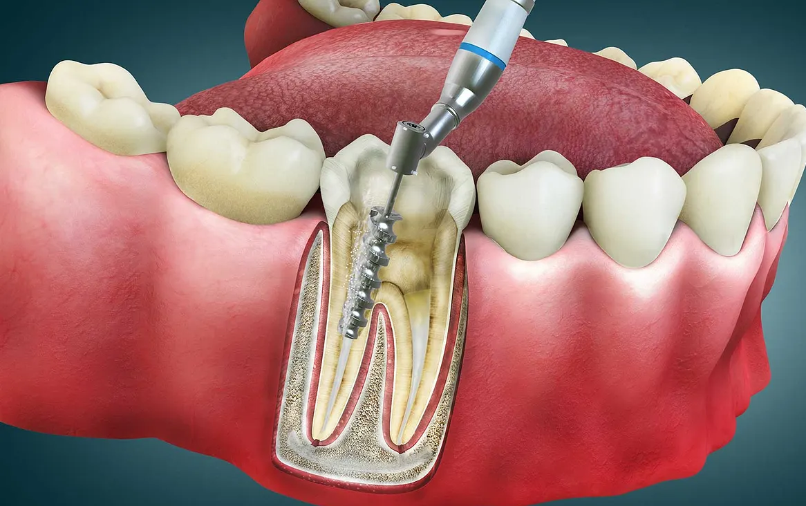 Root Canal Treatment in Islamabad