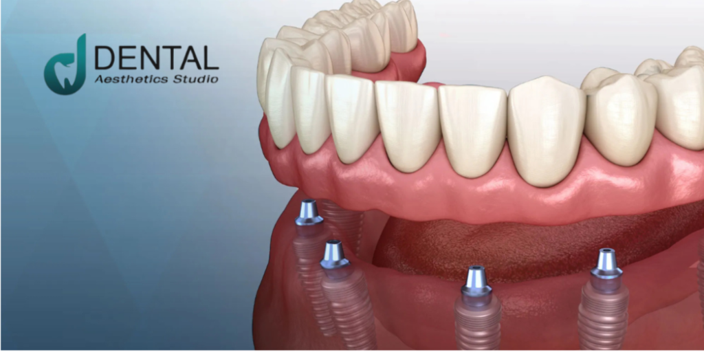 Can Dental Implants Provide a Long-lasting Smile?