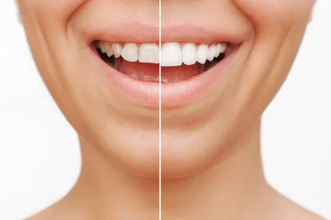 How Many Veneers Are Needed for a Perfect Smile?