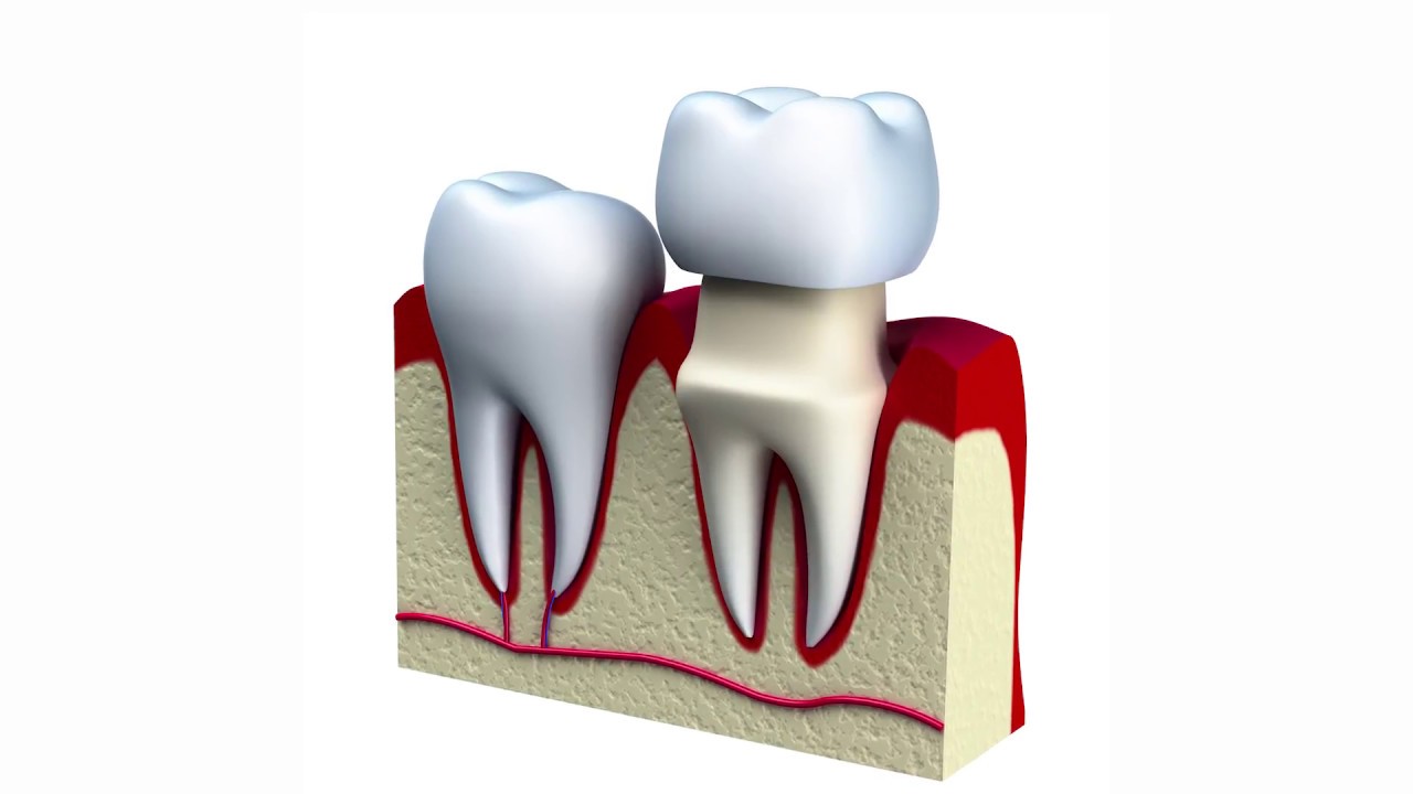 Can I eat normally with a crown?