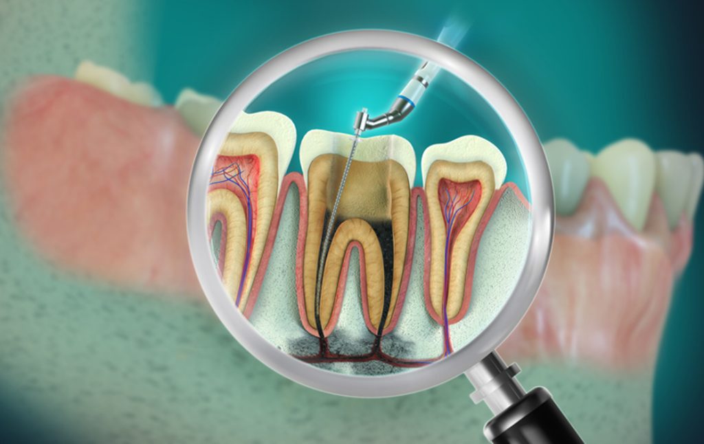 What Is A Root Canal & Should You Get One