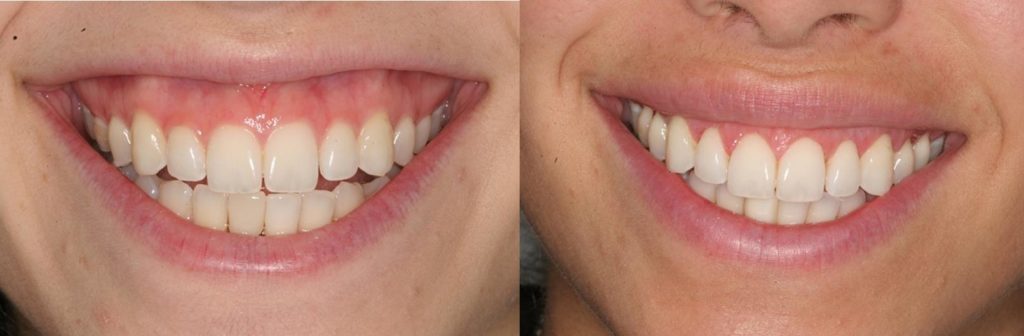 How does surgery fix a gummy smile?