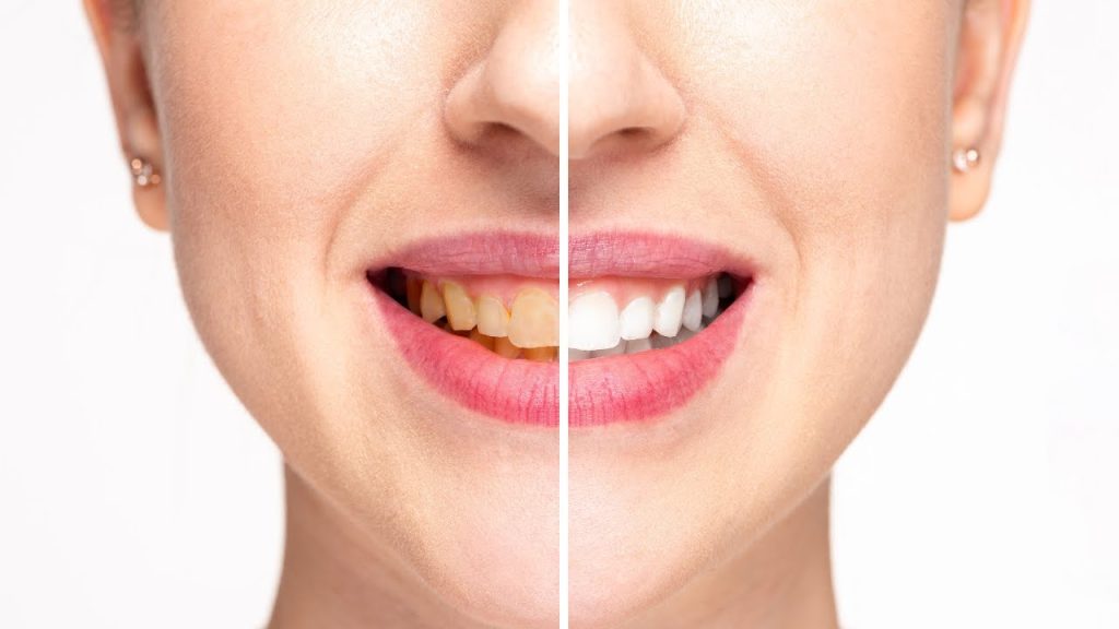 How do teeth whiten naturally?