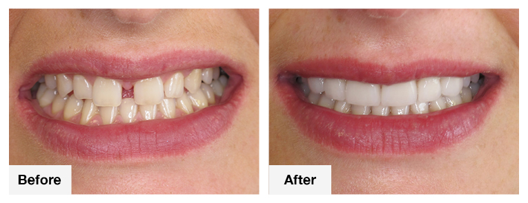 Can Dental Veneers Fix Crooked Teeth Without Braces?