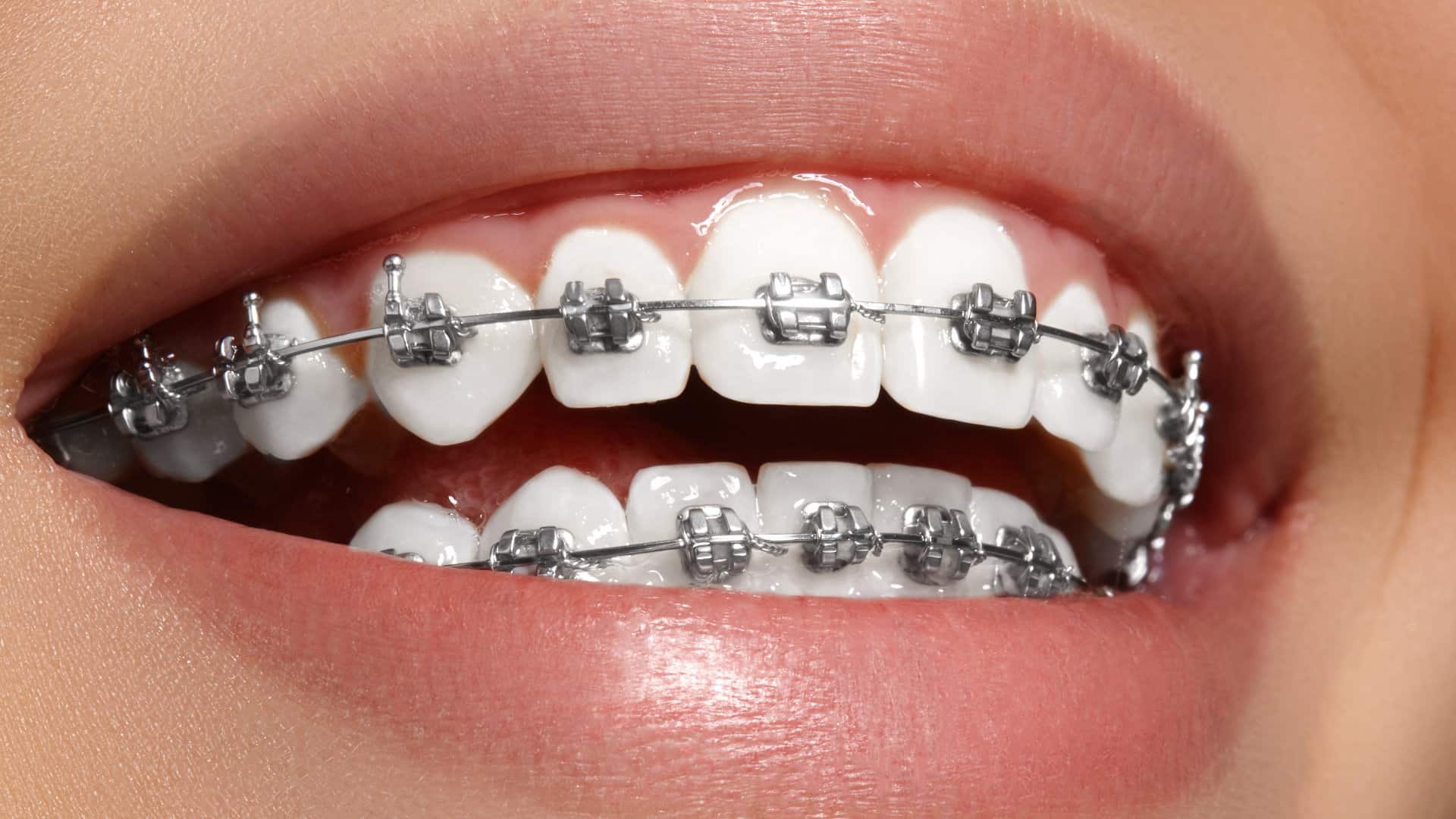 Dental Braces in pakistan