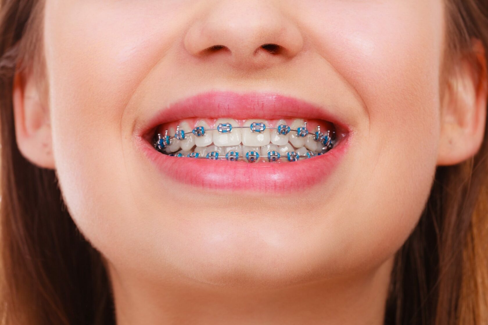 How Can Advanced Dental Braces Give You a Confident Smile