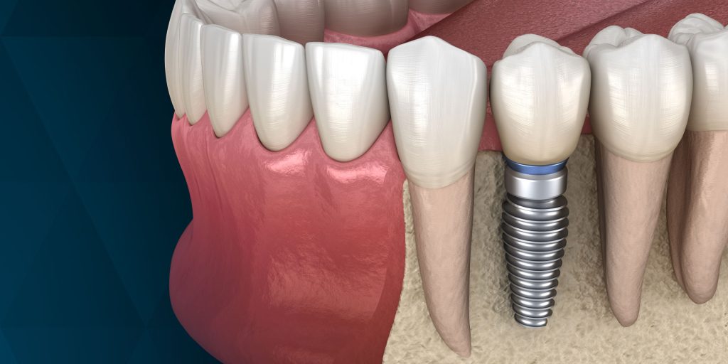What Is the Recovery Time After Dental Implants