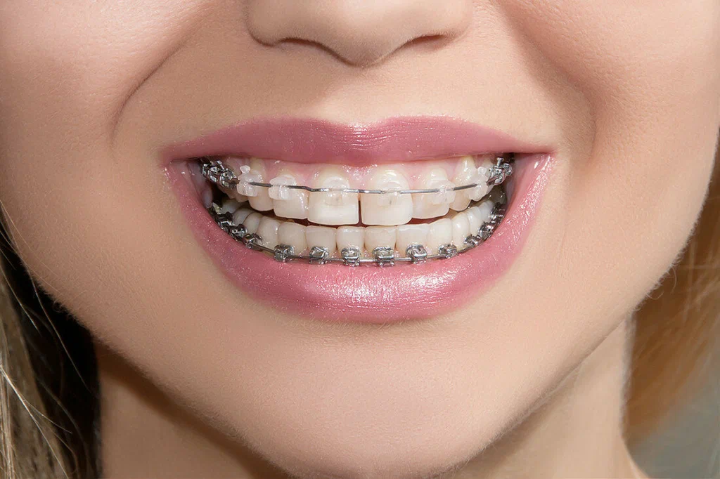How Do You Take Care of Your Teeth with Braces?