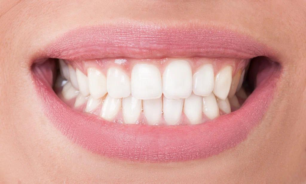 Where Can I Get the Best Teeth Whitening in Islamabad?