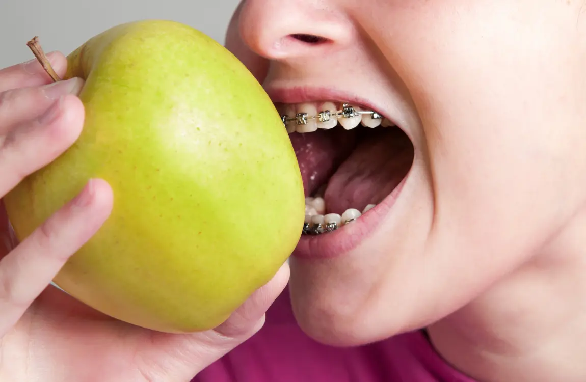 What foods should I avoid with braces?