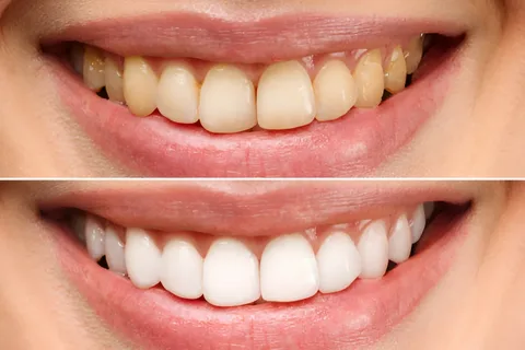 What Do Dentists Not Tell You About Teeth Whitening?