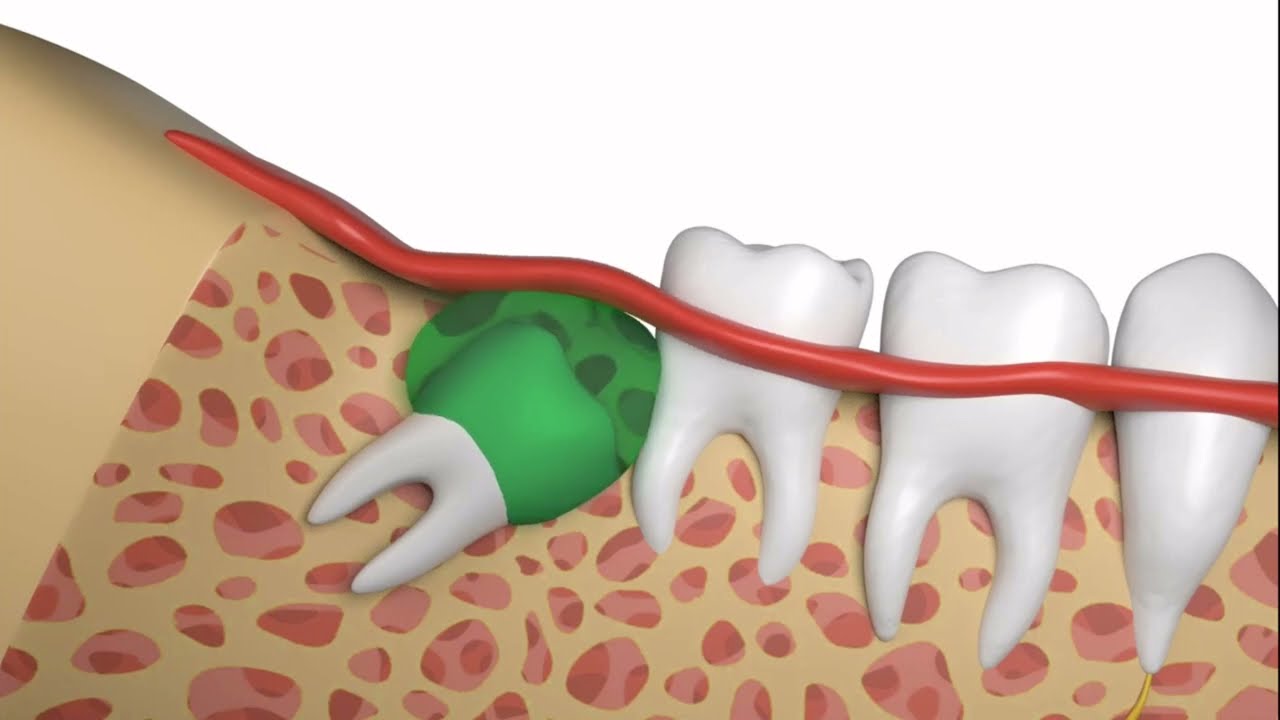 What Happens If I Don’t Remove Impacted Wisdom Teeth?