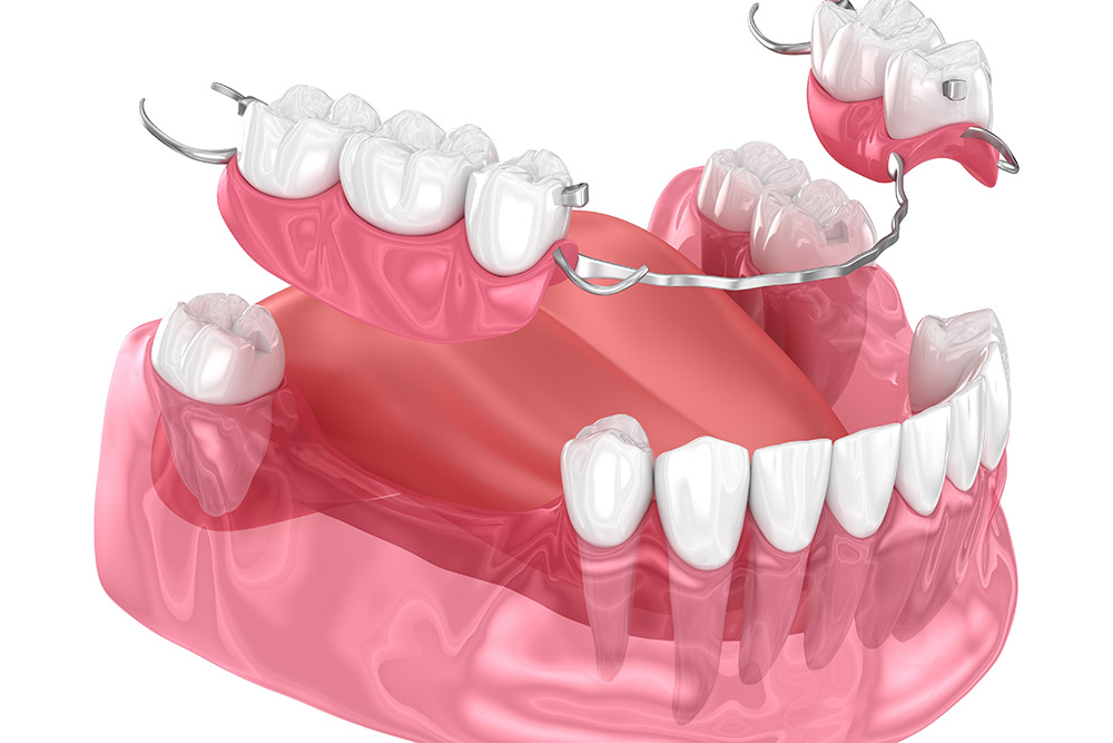 Is Prosthodontics the Right Solution for Missing Teeth?