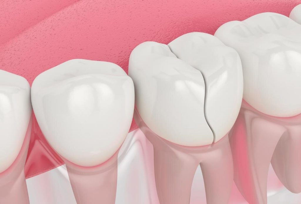 How Do Dental Crowns Restore Damaged Teeth?