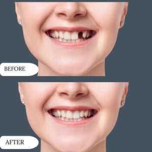 Before After of dental implant in islamabad