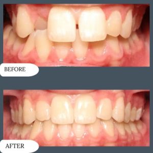 Before after of Overlaping Teeth
