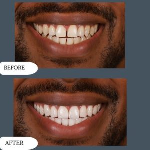 Dental Vaneers in islamabad