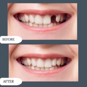 Dental implant cost in islamabad