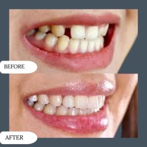 Dental implant in islamabad pakistan