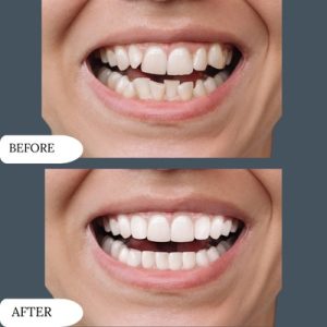 Dental vaneers Price in pakistan