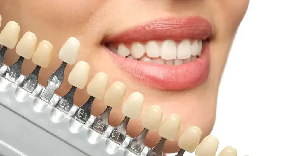 Who Is the Best Candidate for Dental Veneers?