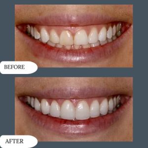 Gummy smile Treatment in Pakistan