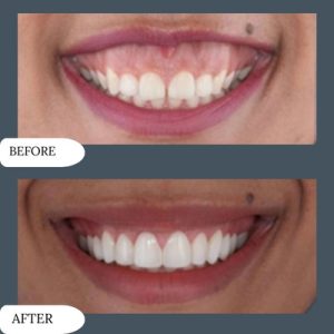 Gummy smile treatment cost in islamabad