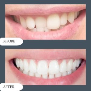 Overlaping Teeth Cost in Islamabad