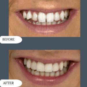 Overlaping Teeth Treatment in Islamabad