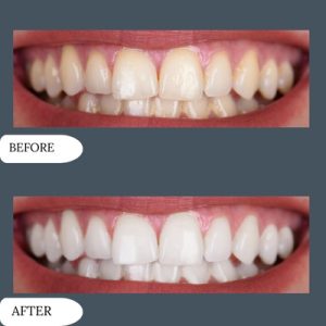 Teeth Whitening in islamabad