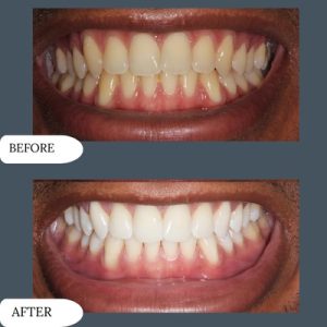 Teeth whitening cost in pakistan