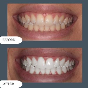 Teeth whitening in pakistan