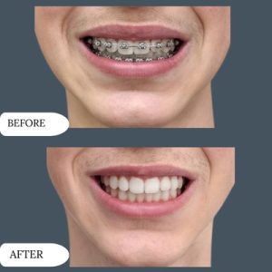 Dental Braces in Islamabad