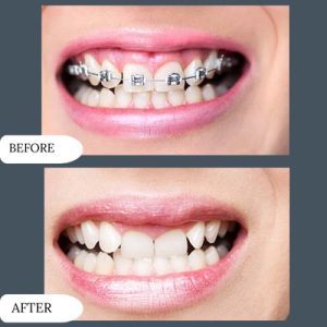  Dental Braces in Islamabad 