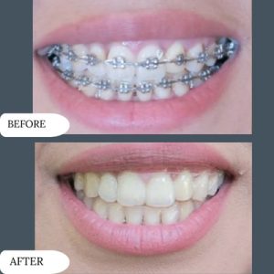  Dental Braces in Islamabad 