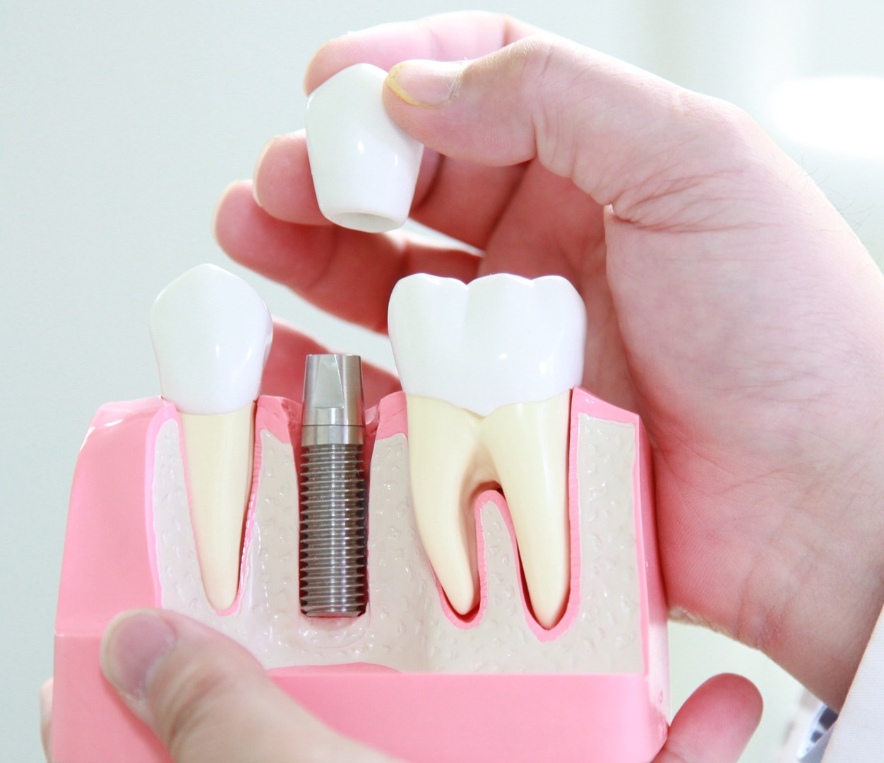 Can Prosthodontic Treatment Fix Severe Tooth Wear?