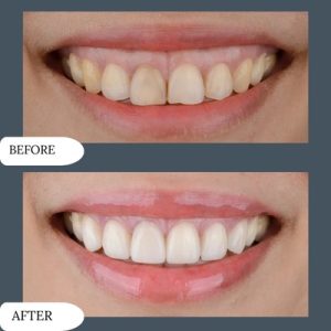 gummy smile Treatment in islamabad