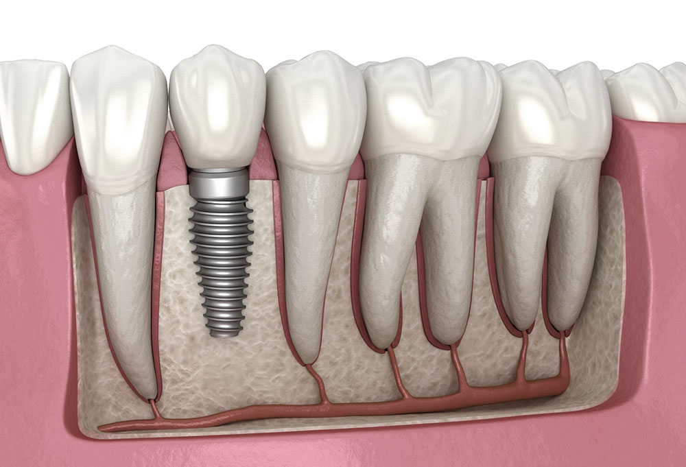 How much does a 4 in one implant cost in Islamabad?