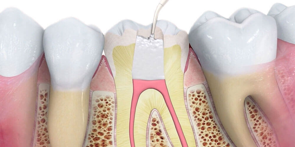 Do I need antibiotics after a root canal?