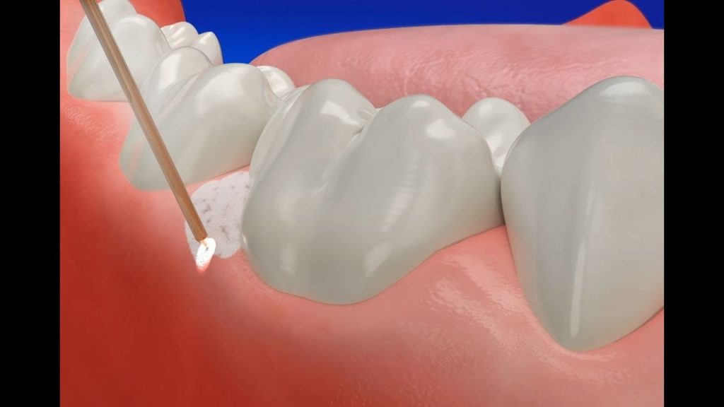 Can a gum pocket go away?