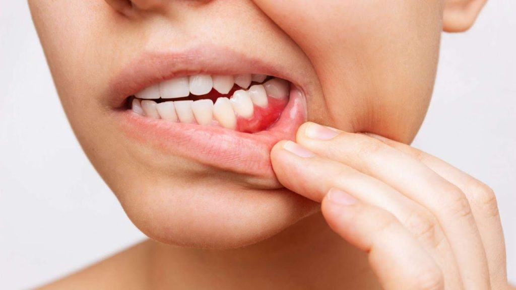 : Can gum disease affect the heart?