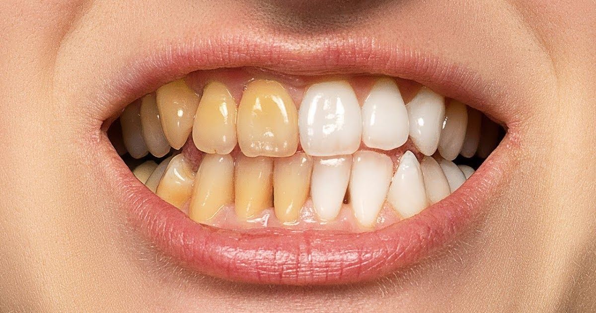 an yellow teeth go white again?